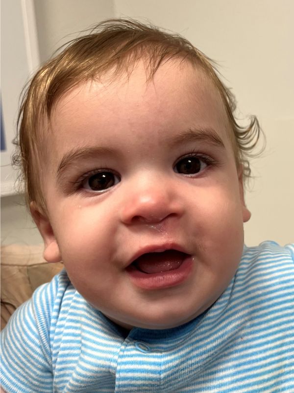 A toddler boy after surgery for cleft lip.